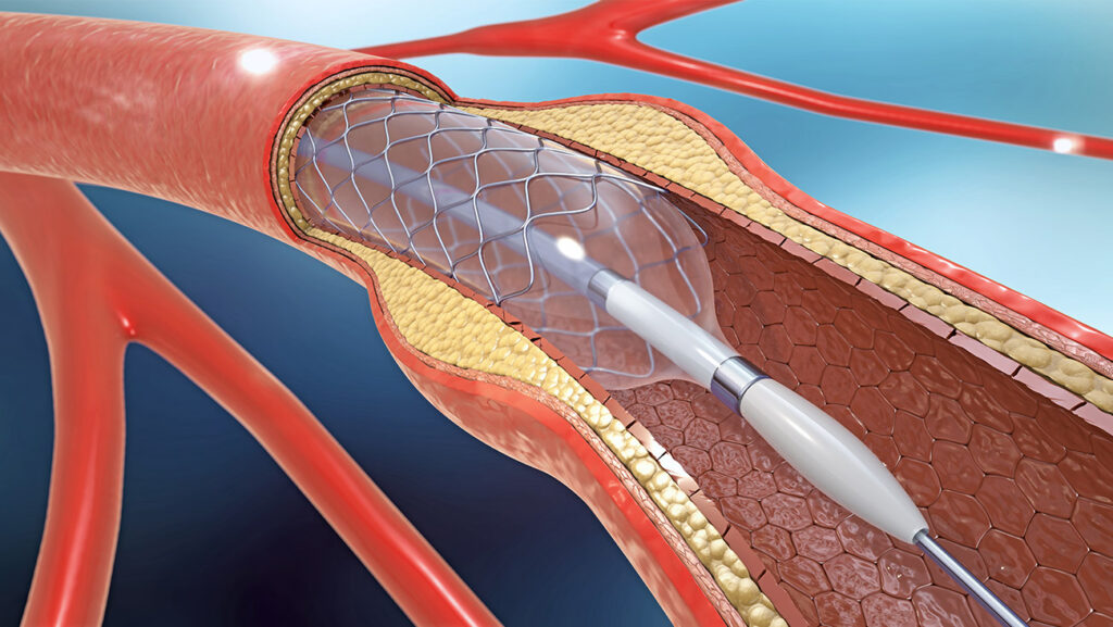 Image of a medical device breaking a blockage in a vein