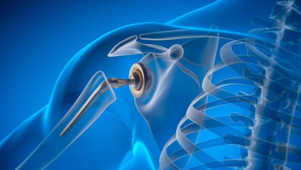 Medical Device Laser Cutting: Precision Solutions for Complex Components